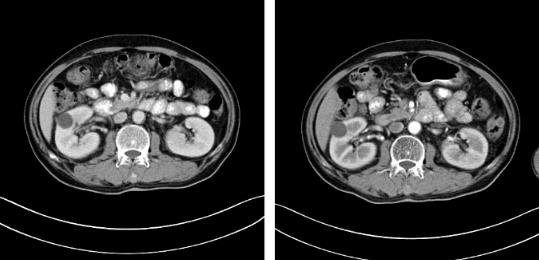蘇州腫瘤醫院認準廣州復大醫院：有效治療雙腎腎癌