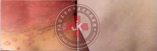 許光生：多年兒童牛皮癬終于治好，兒童牛皮癬怎么治