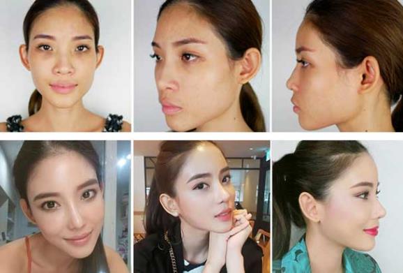 韋元強講解:瘦子也適合做自體脂肪填充嗎?