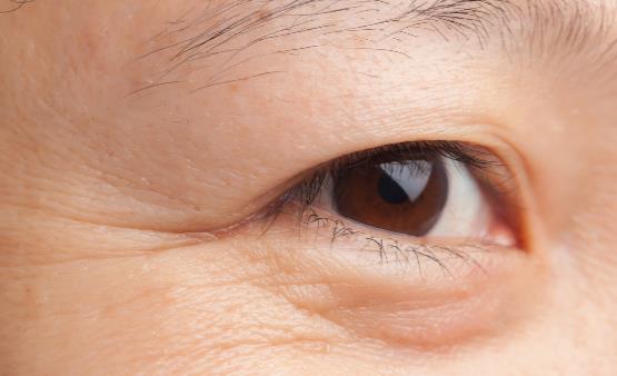 眼角皺紋長(zhǎng)出來(lái)了 6個(gè)方法能祛除