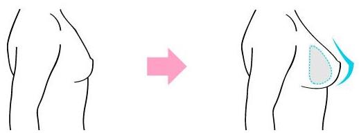 原來假體隆胸還可以這樣解釋！