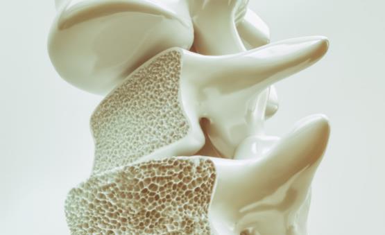 骨質疏松的認知誤區你中了沒 骨質疏松的飲食保健