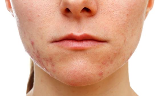 下巴長痘痘怎么辦 祛痘小竅門