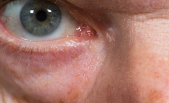 總是熬夜竟然出現了眼袋 日常哪些方法能祛眼袋