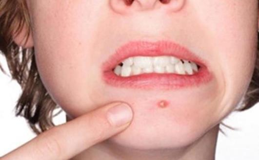 祛痘印小竅門學起來 讓女性顏值隨時在線