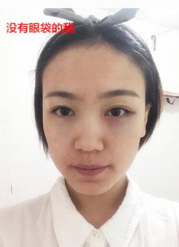 衛婭日記:我一直都以為眼袋對我的影響只是美觀,直到我了解了以后……