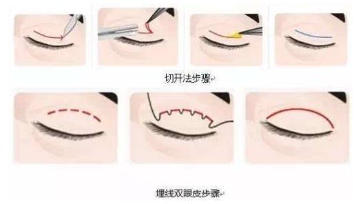 上海玫瑰整形醫院雙眼皮手術怎么樣?輕松擁有靚麗雙眼