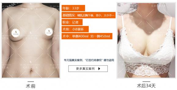 韋元強：產后能做自體脂肪豐胸嗎？