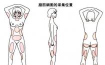 韋元強：產(chǎn)后能做自體脂肪豐胸嗎？