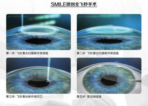 西安普瑞眼科醫(yī)院好嗎？戴眼鏡VS近視手術(shù)，四個對比讓你不糾結(jié)
