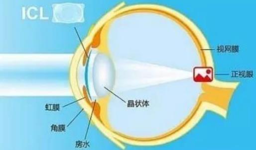 西安普瑞眼科醫(yī)院好嗎？戴眼鏡VS近視手術(shù)，四個對比讓你不糾結(jié)