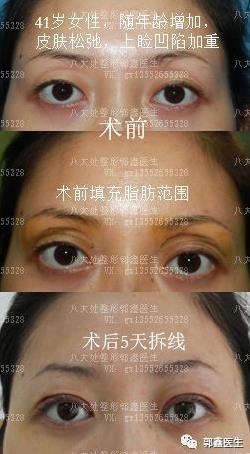 八大處整形郭鑫:上眼瞼凹陷脂肪填充圖片