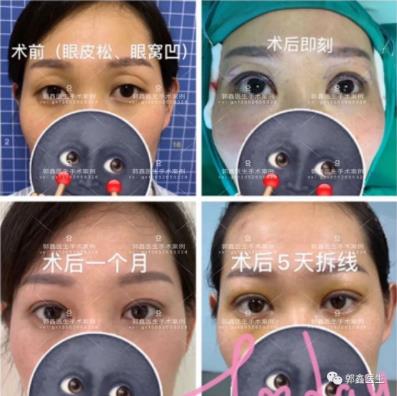 八大處整形郭鑫:上眼瞼凹陷脂肪填充圖片