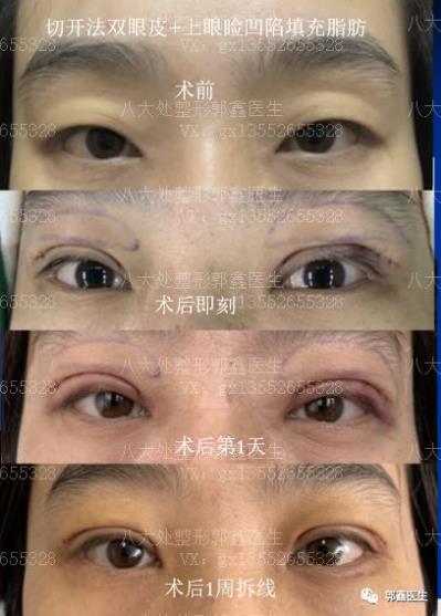 八大處整形郭鑫:上眼瞼凹陷脂肪填充圖片