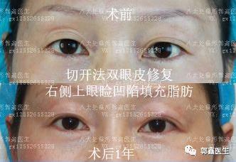 八大處整形郭鑫:上眼瞼凹陷脂肪填充圖片
