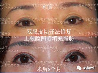 八大處整形郭鑫:上眼瞼凹陷脂肪填充圖片