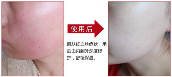 放心！有美薏升修復(fù)敏感肌紅血絲專家產(chǎn)品在，你每天都可以美美噠