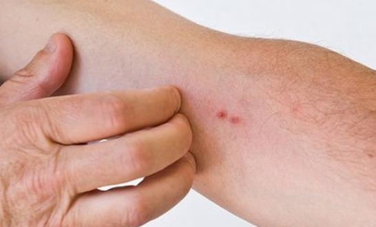 蕁麻疹影響生活工作 蕁麻疹的治療方法